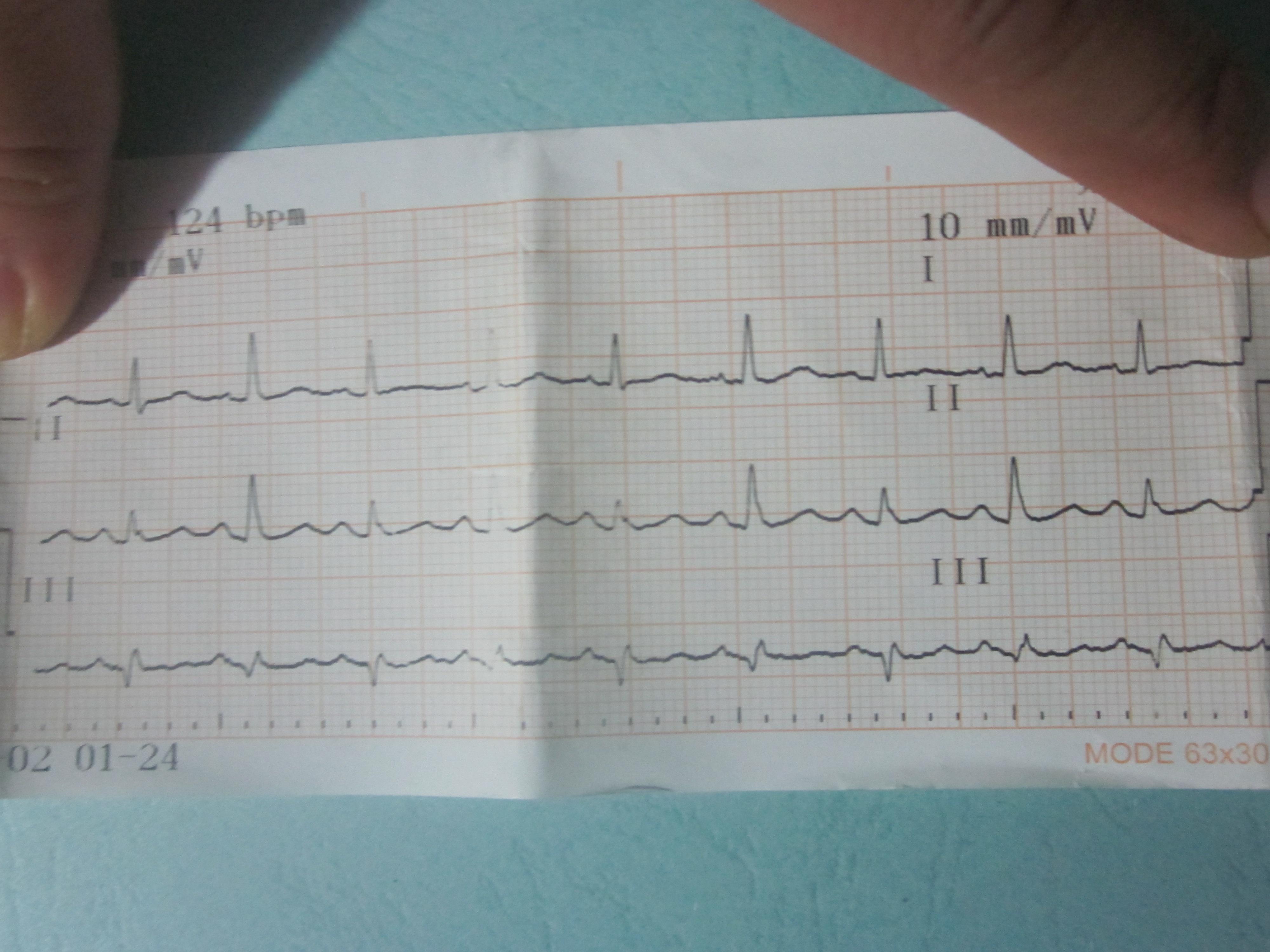 经典图一例,供大家欣赏(大量心包积液引起的qrs波群电交替)
