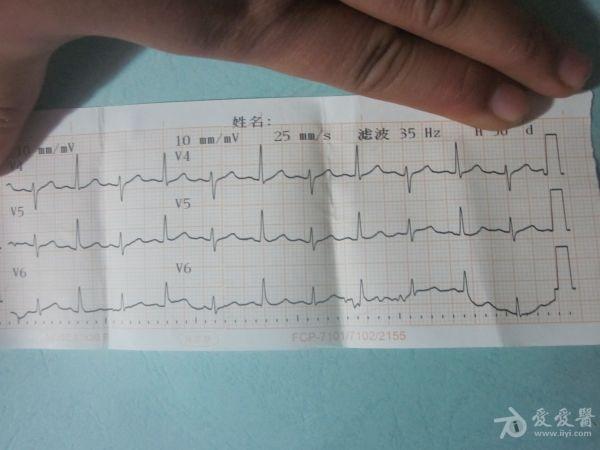 急性心包炎心电图图片