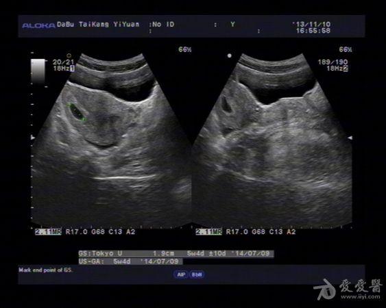 宫角妊娠声像图表现图片