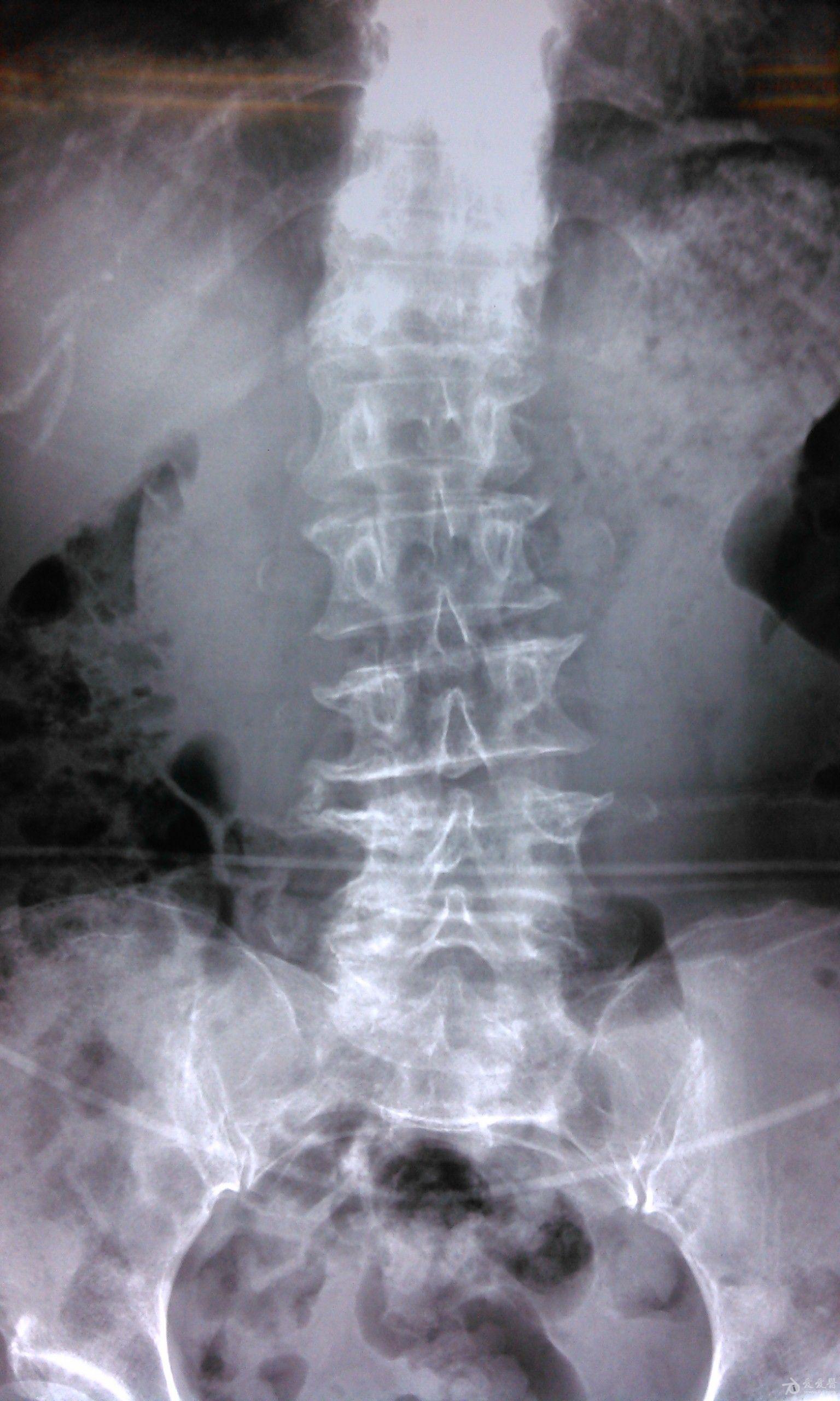 腰椎间盘突出,腰椎滑脱并椎管狭窄一例