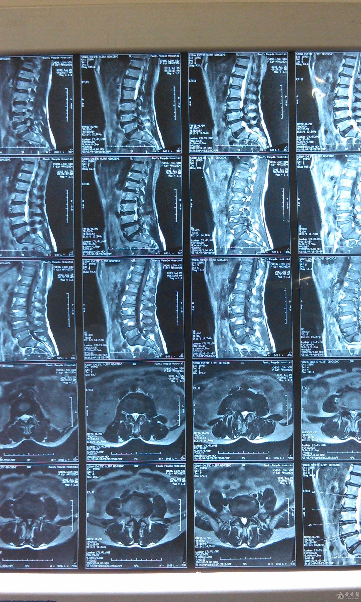 腰椎间盘突出