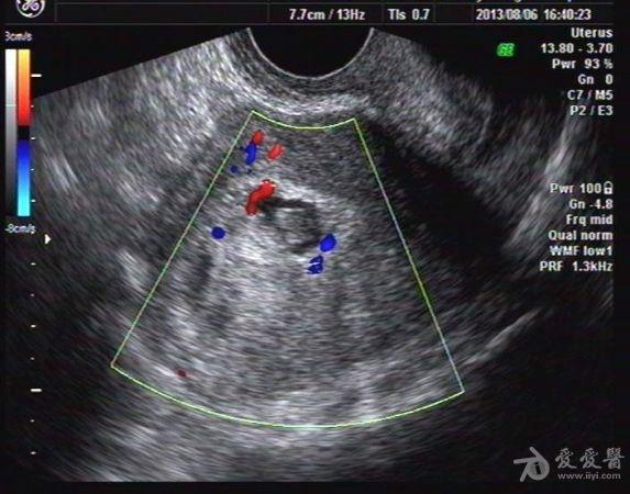 葡萄胎 7天的超声变化