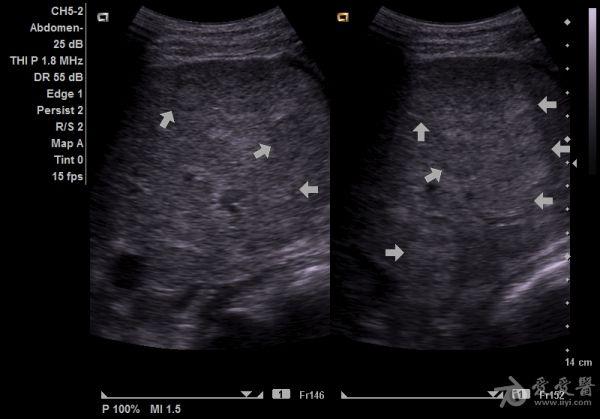 转移性肝癌超声图片图片