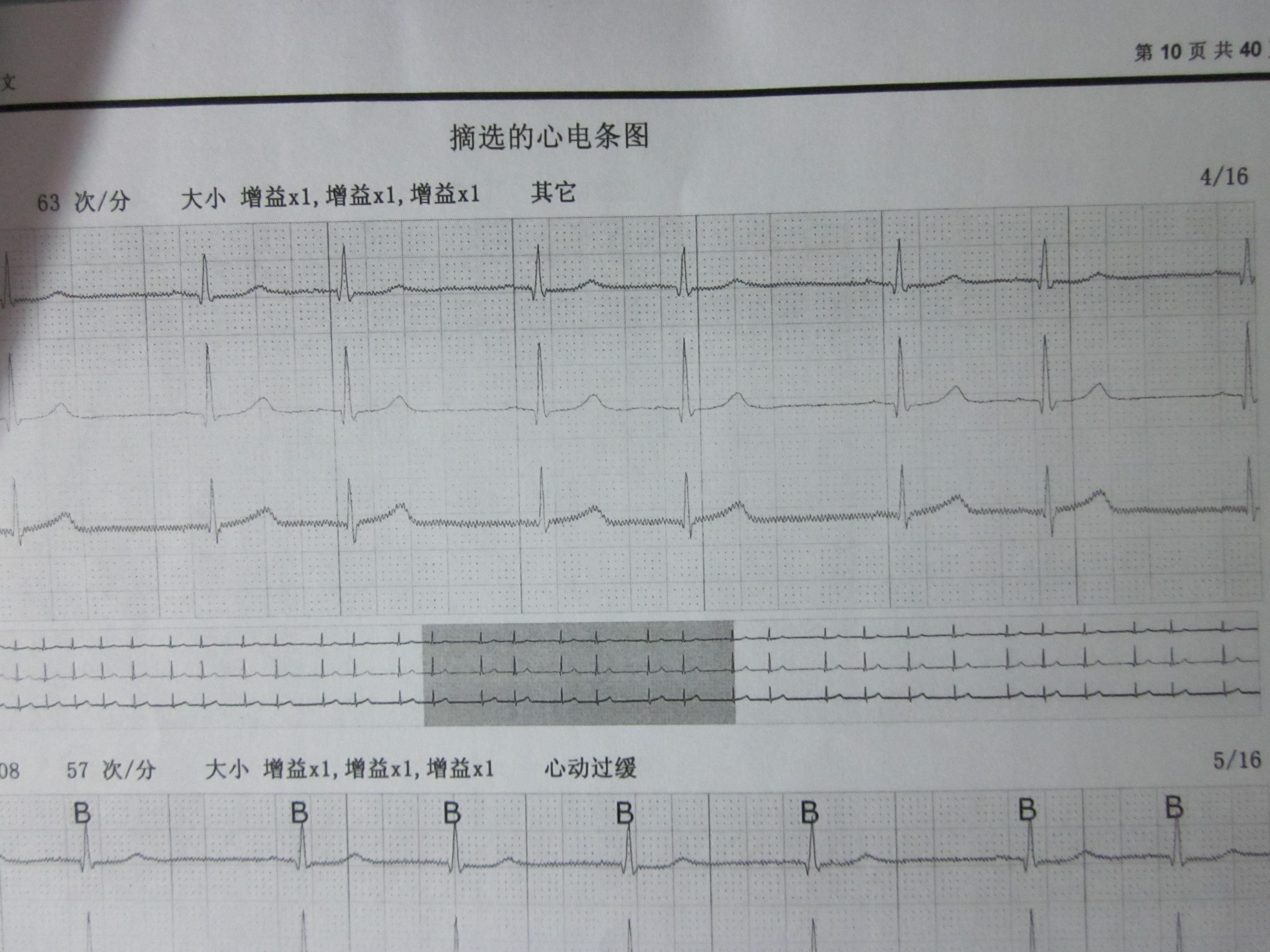 房早二聯律,後做24小時動態心電圖檢查,提示竇性心律不齊,因全圖均以