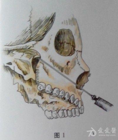 耳鼻咽喉头颈外科手术征集——上颌窦根治术