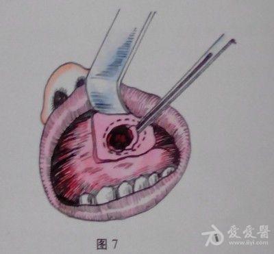 耳鼻咽喉头颈外科手术征集——上颌窦根治术