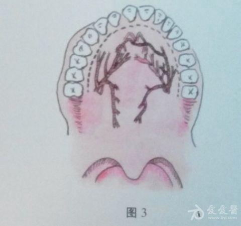 耳鼻咽喉头颈外科手术征集——鼻咽血管纤维瘤切除术