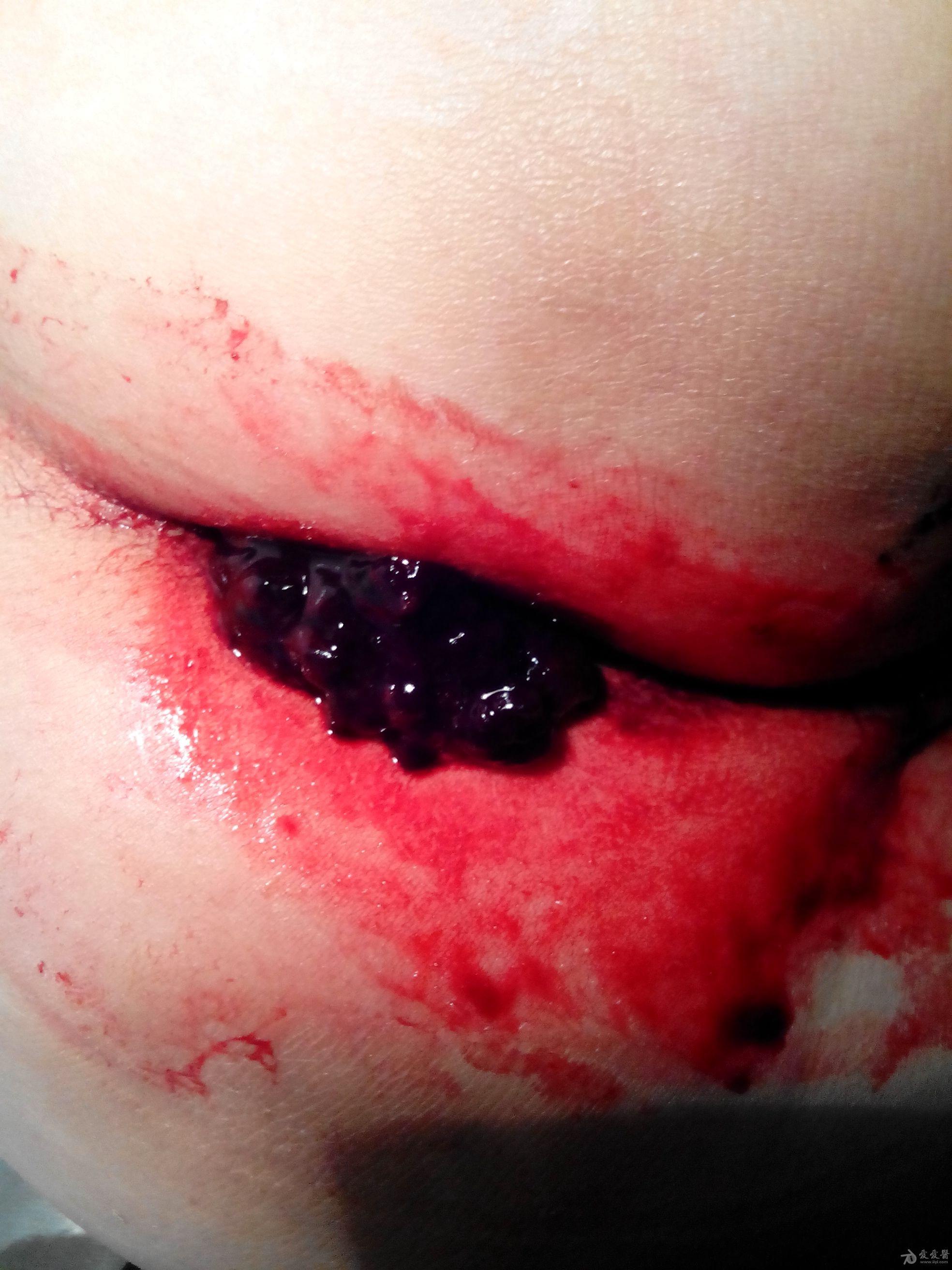 一例门诊以"环状混合痔嵌顿出血"入院的直肠包块脱出