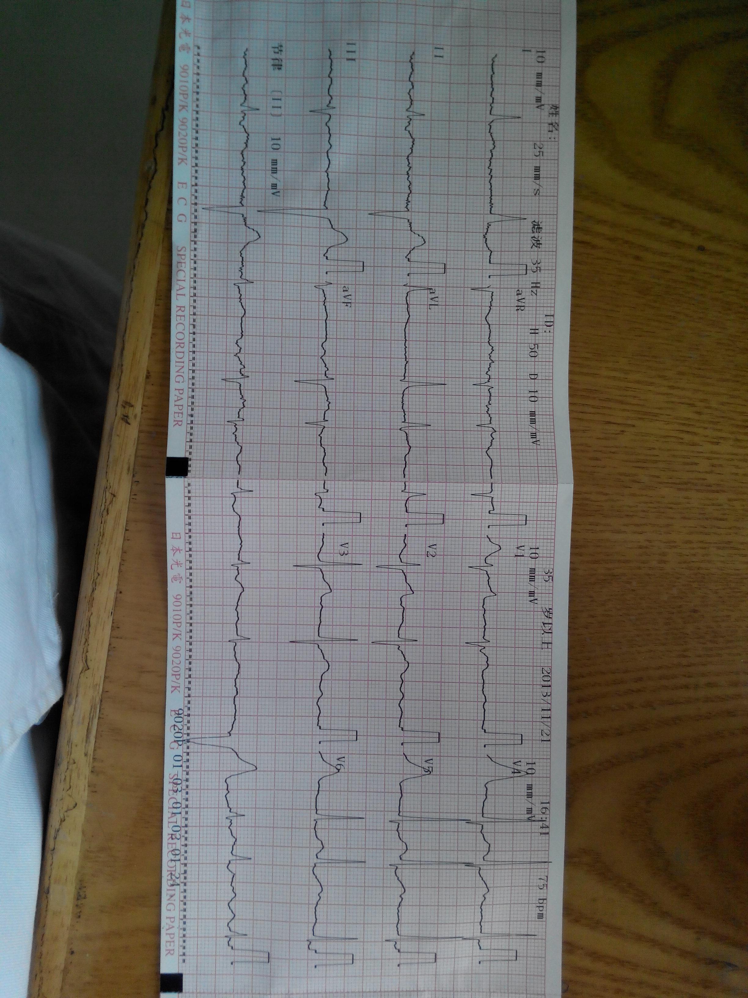心电图求助
