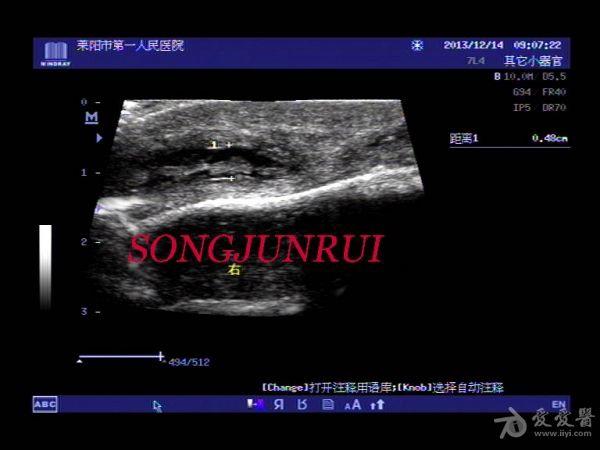 超声入门贴312-肌骨超声(鹰嘴滑囊炎超声图 体表图)