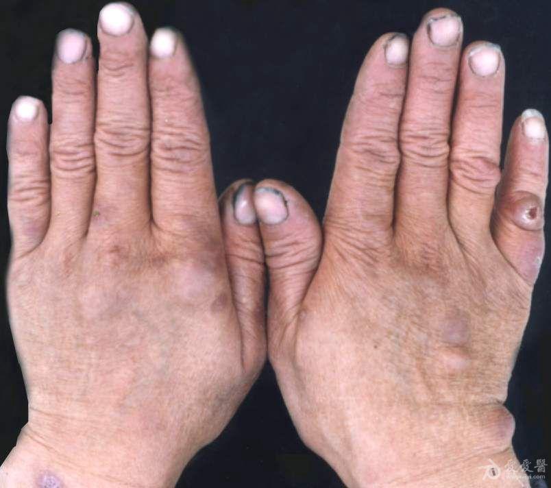 皮肤性病图谱☆有☆奖☆点☆评☆33:麻风.