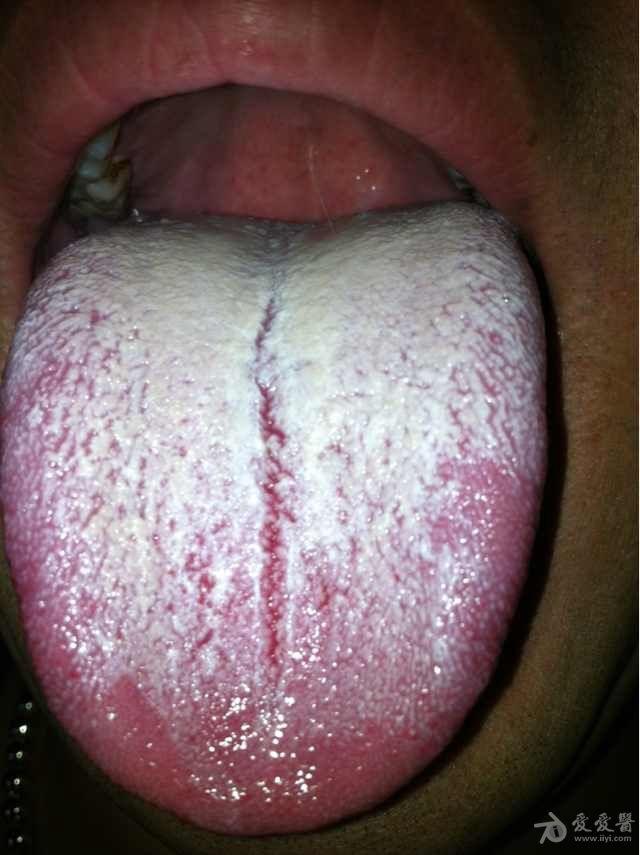 牛口蹄疫舌头症状图片图片