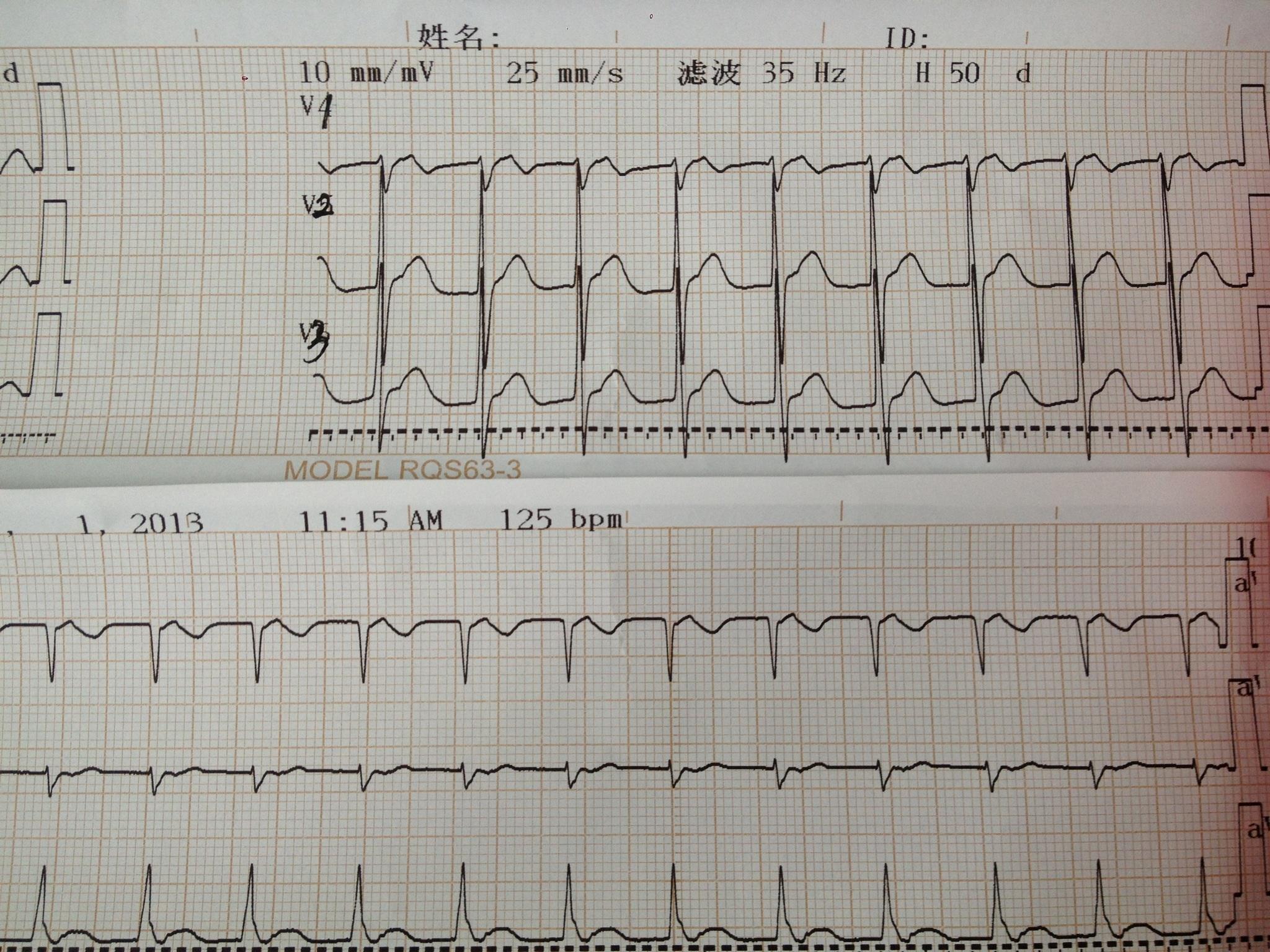 这又是什么?折返性心动过速?