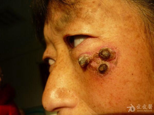 面部左侧起丘疹,呈疣状突起,无自觉症状,已3个月.