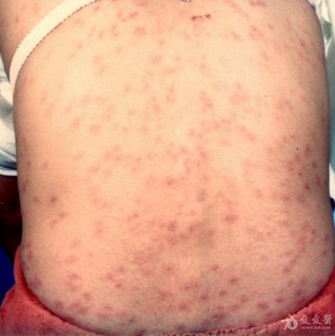 梅毒疹出现部位皮肤图片