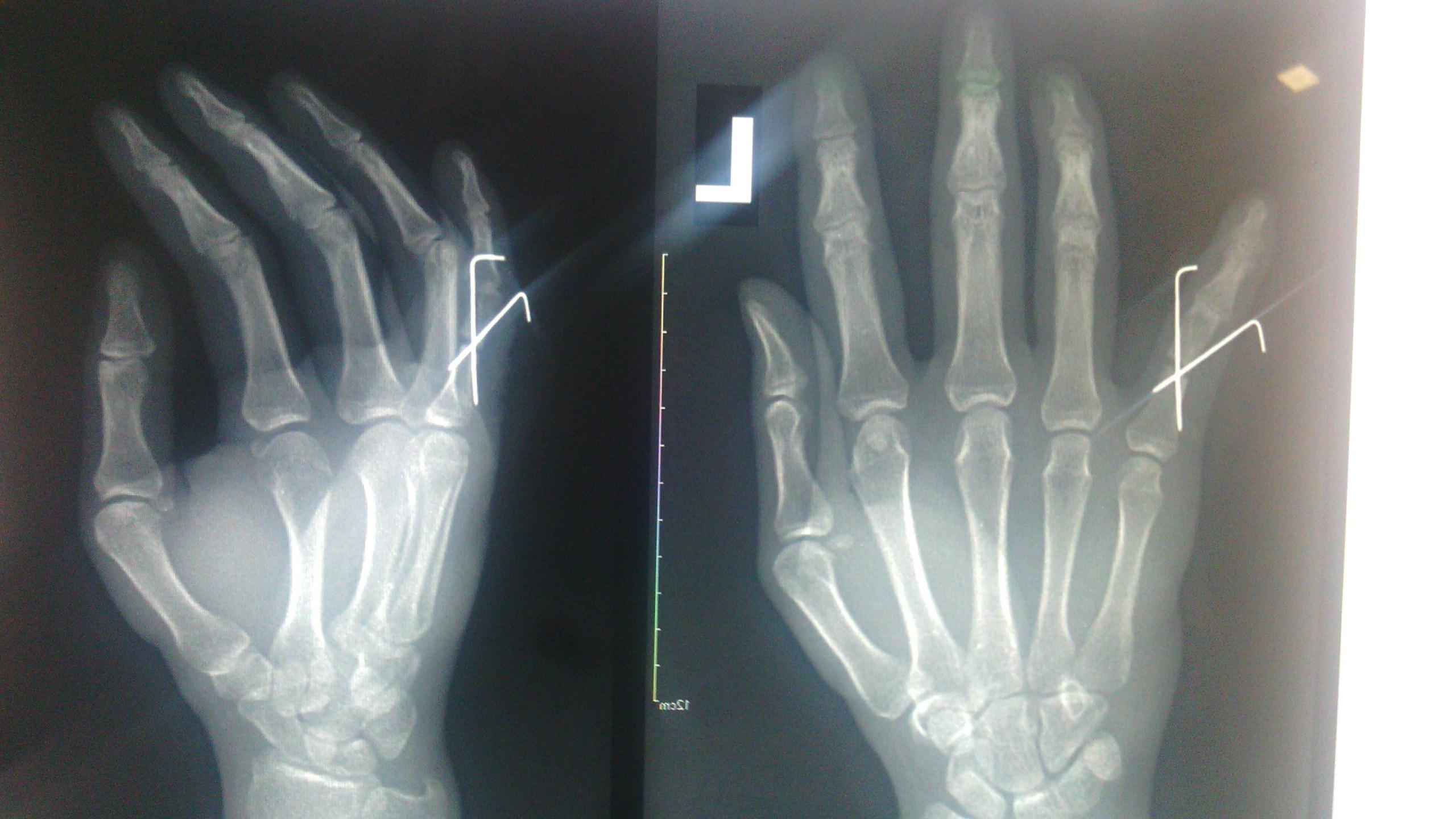 手指头骨折照片 右手图片