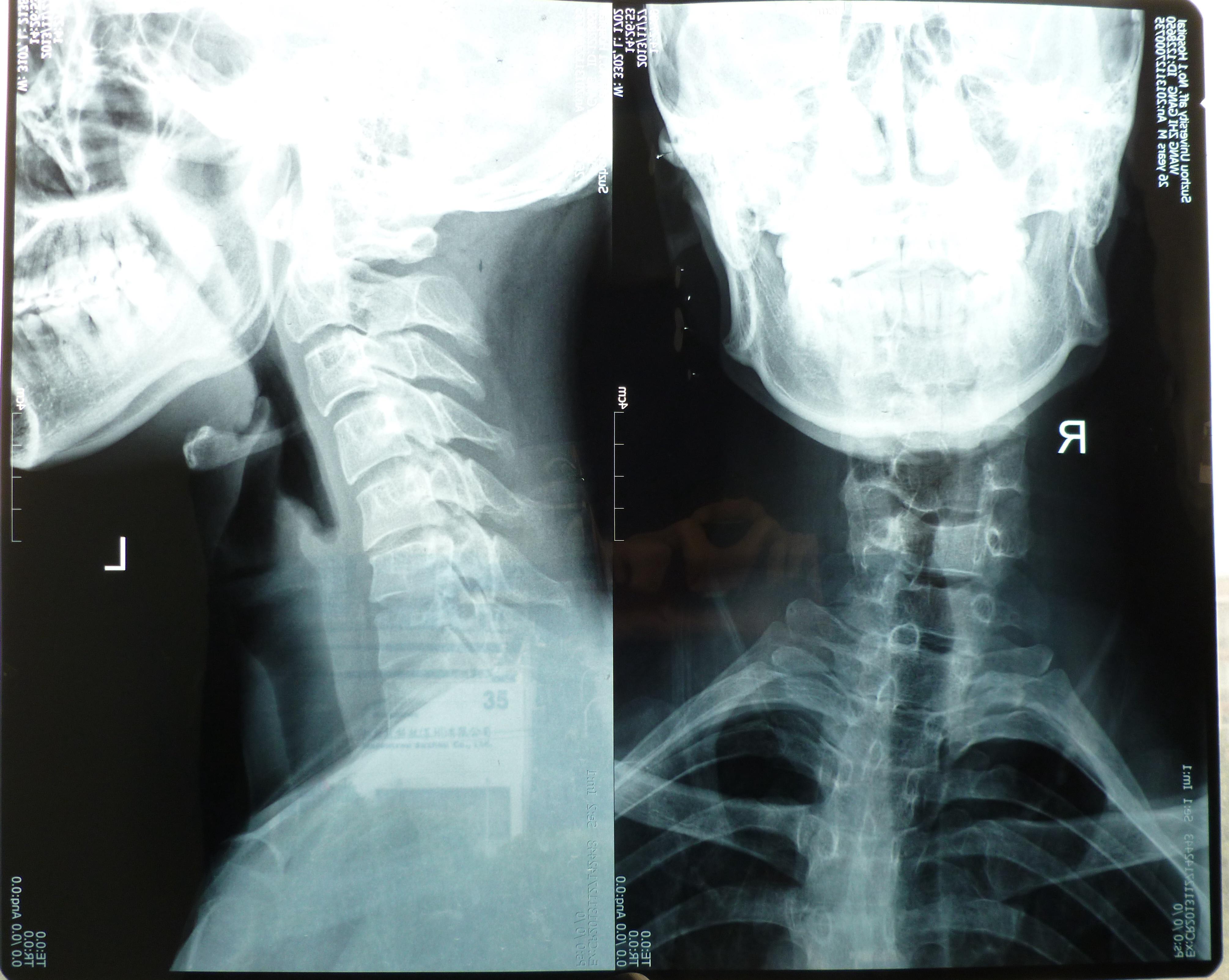 颈椎测弯 颈椎间盘突出 28岁(定期更新治疗进展,欢迎讨论)