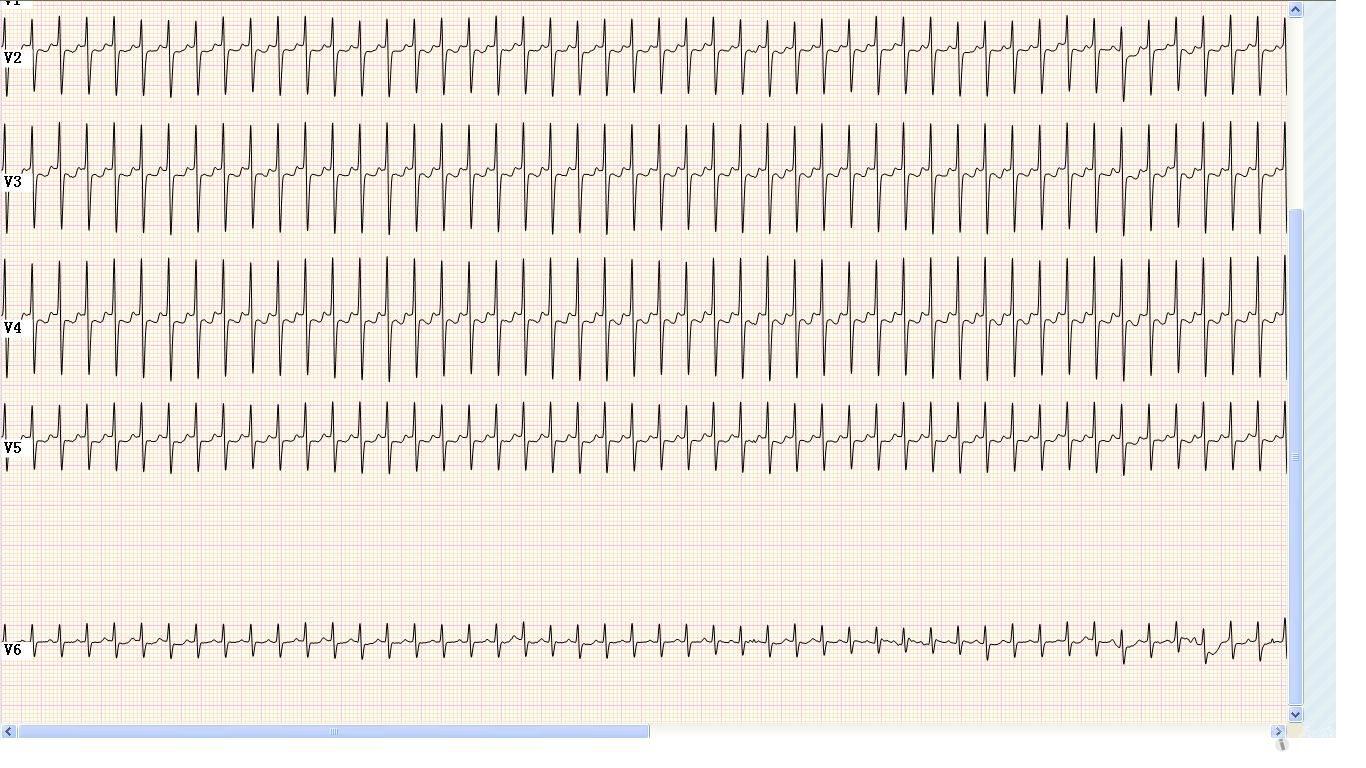 请山羊老师和版主看看,这是窦速还是房速啊 心电图脑电图专业讨论版
