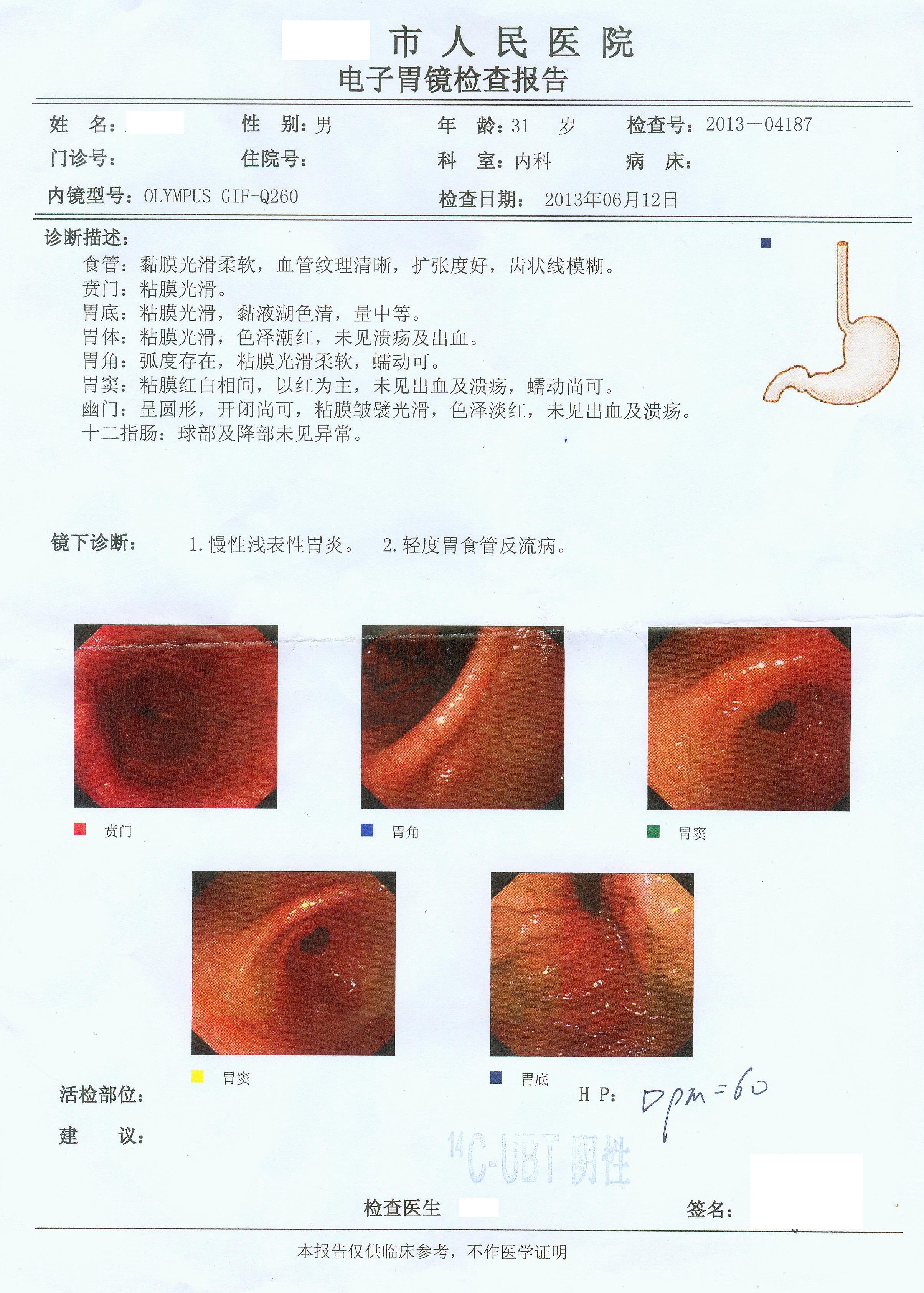 剑突处不明原因疼痛