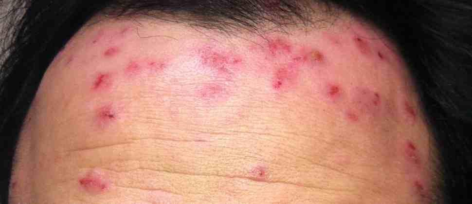 鸡皮肤神经性皮炎湿疹(鸡皮肤神经性皮炎湿疹图片)