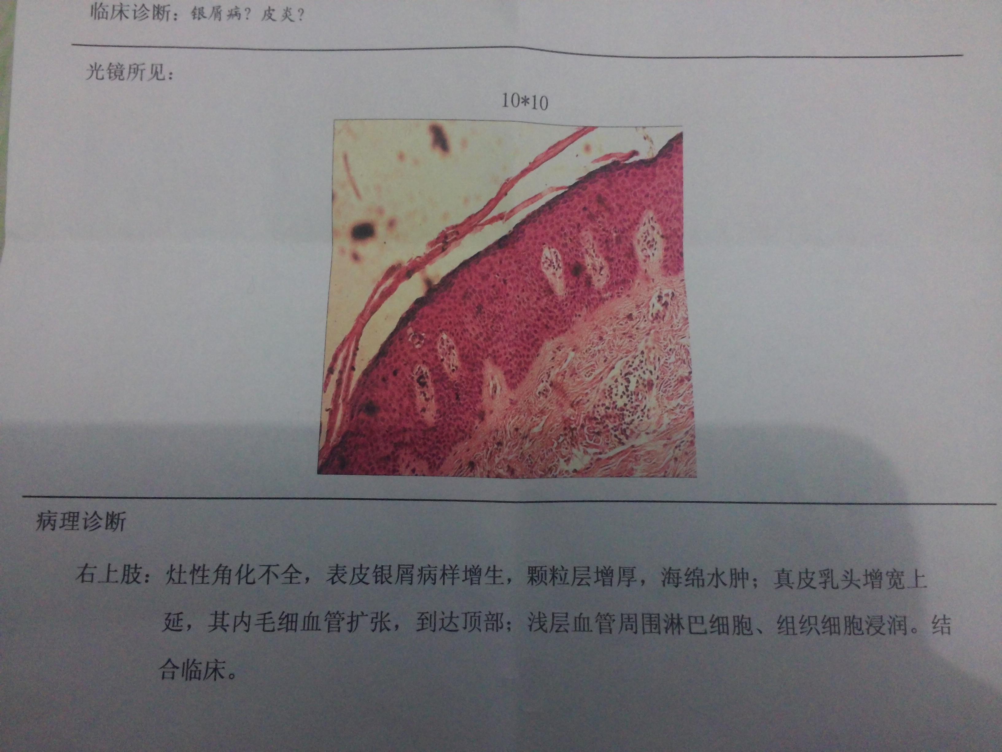 求诊断:无诱因自动发病,小斑块副银屑病样皮损