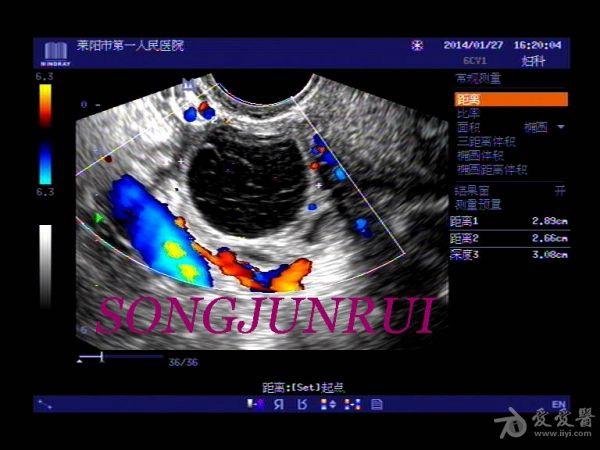 黄体囊肿的超声图片图片