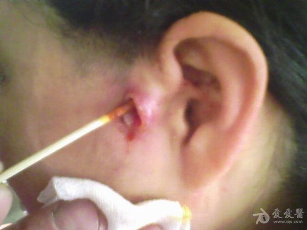 耳前瘘管术后患者一例