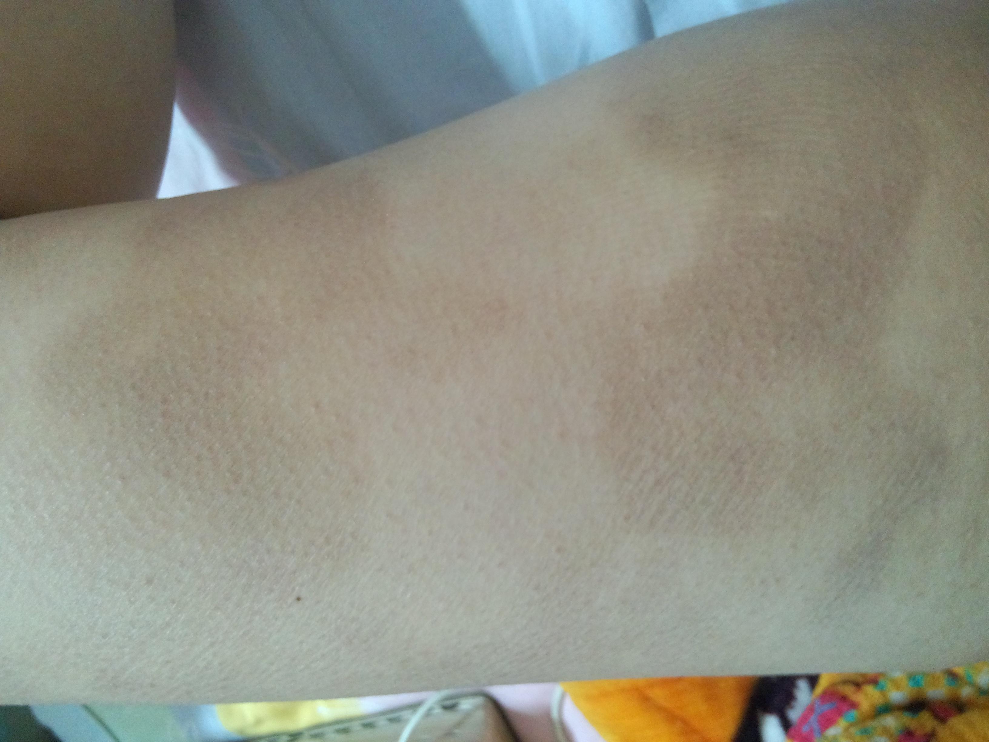 我今年二十七岁, 但是从12岁那年长了怪病 , 全身皮肤长斑 颜色青