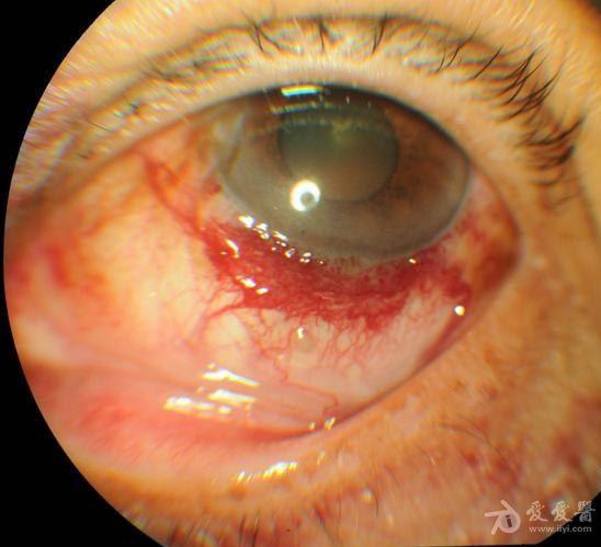 眼结膜血管瘤图片