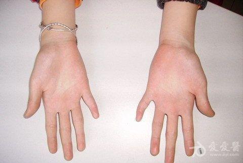 第五掌骨,第四第五跖骨发育障碍一例