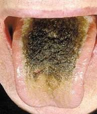 黑毛舌症状图片图片