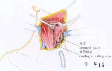 平舌骨下緣切斷帶狀肌翻向下,於中線或稍偏健側切開甲狀軟骨膜,橫行