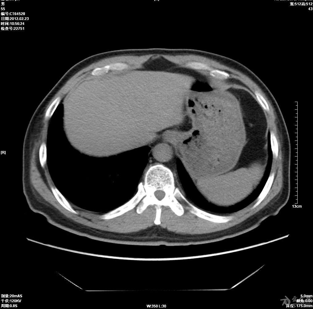 请老师们看看横隔的ct,是隔疝吗?