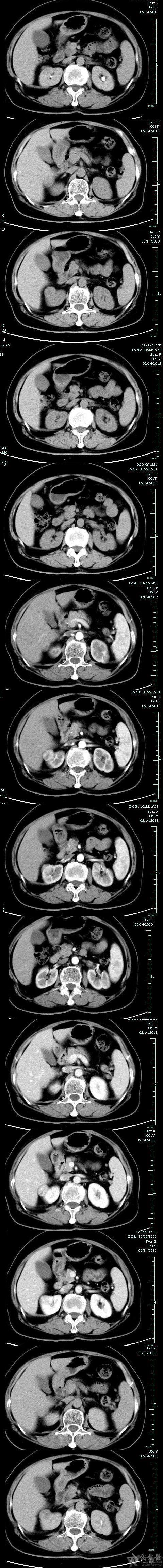 (右肾)嫌色细胞癌