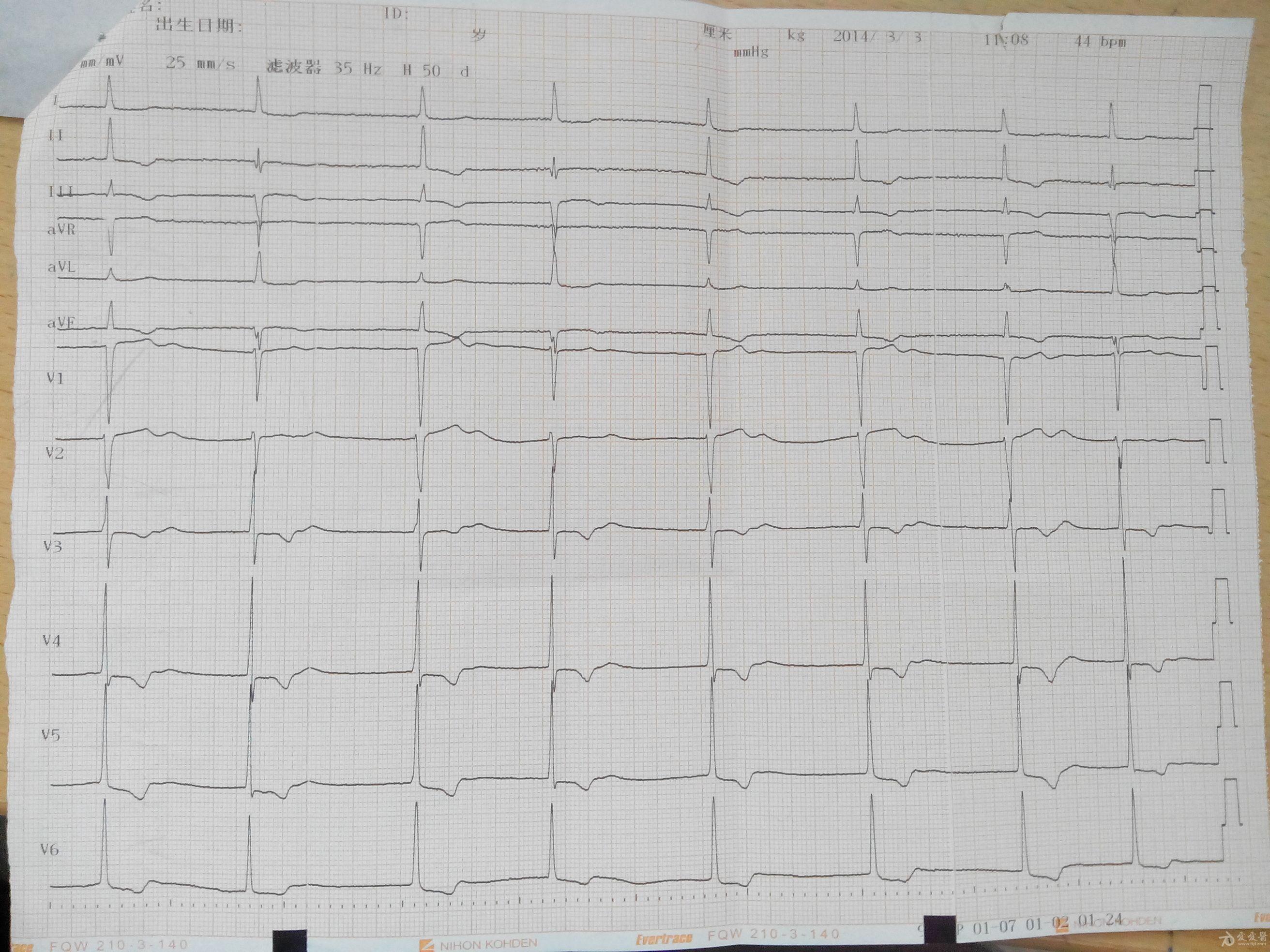 交界性心律心电图标准图片
