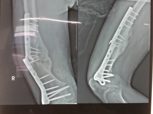 学平险报销钢板吗 学平险骨折钢板及钉报销多少钱