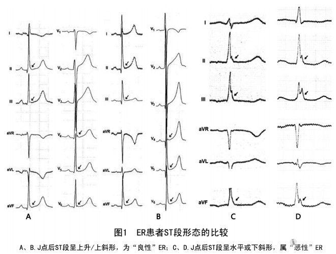 心电图早期复极图片