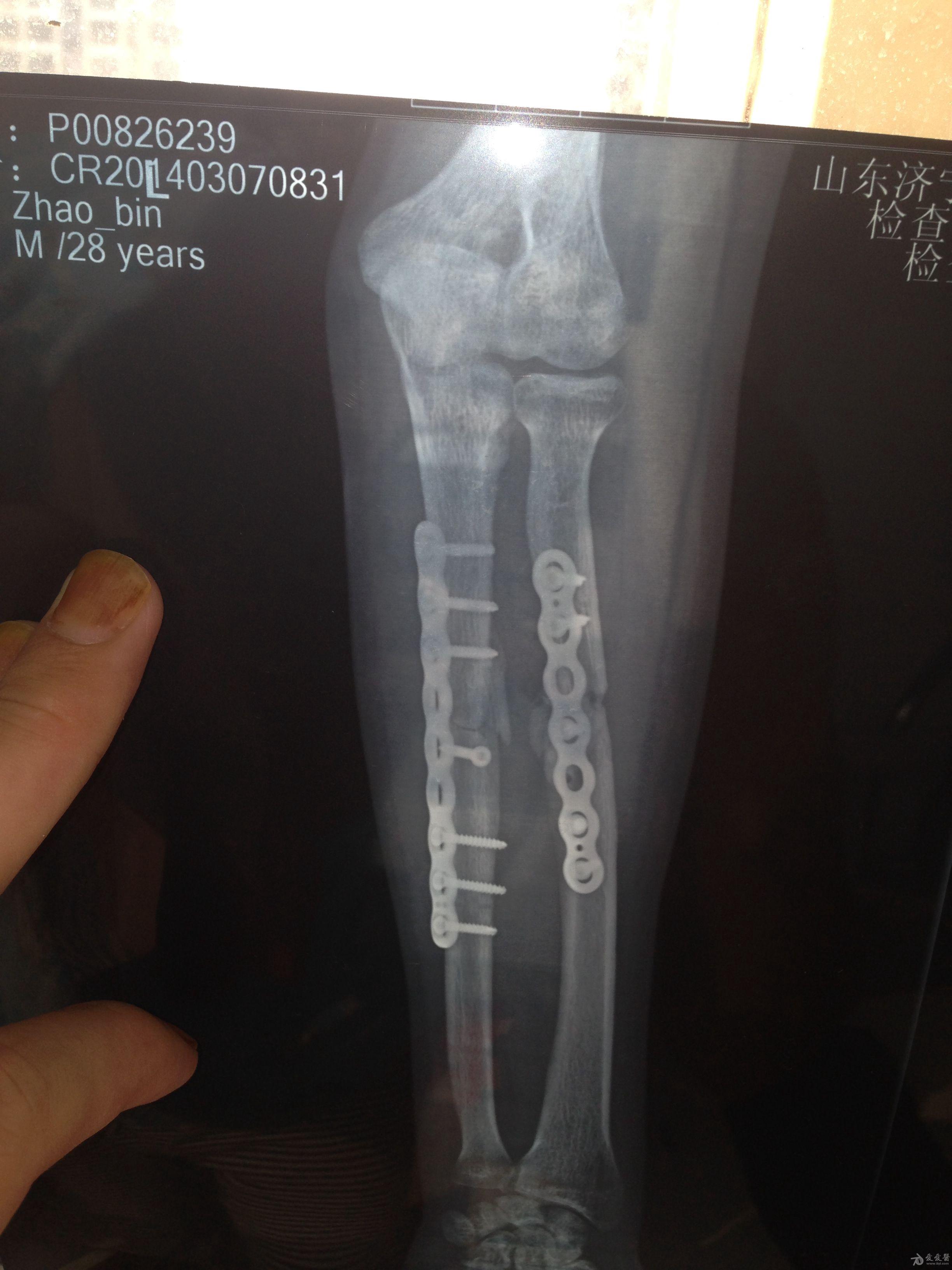 尺桡骨骨折三个月复诊
