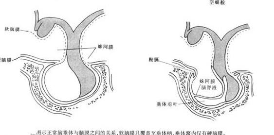 空泡蝶鞍综合症