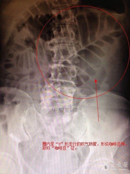 小肠扭转x线图片图片