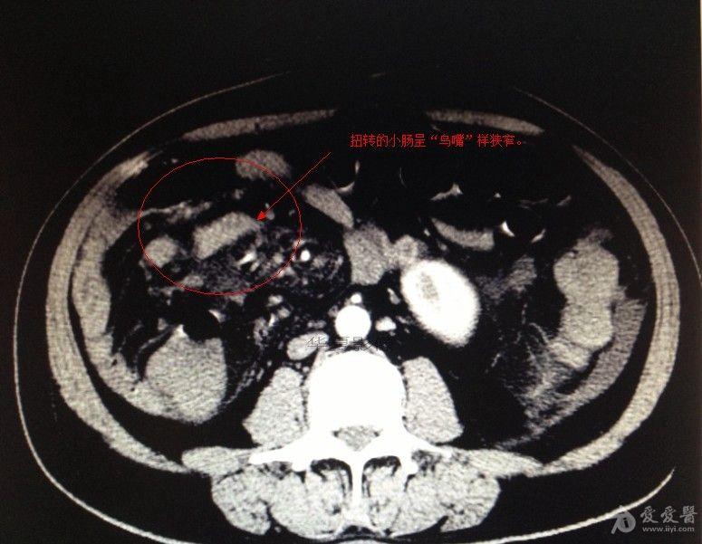 肠系膜扭转ct表现图片图片