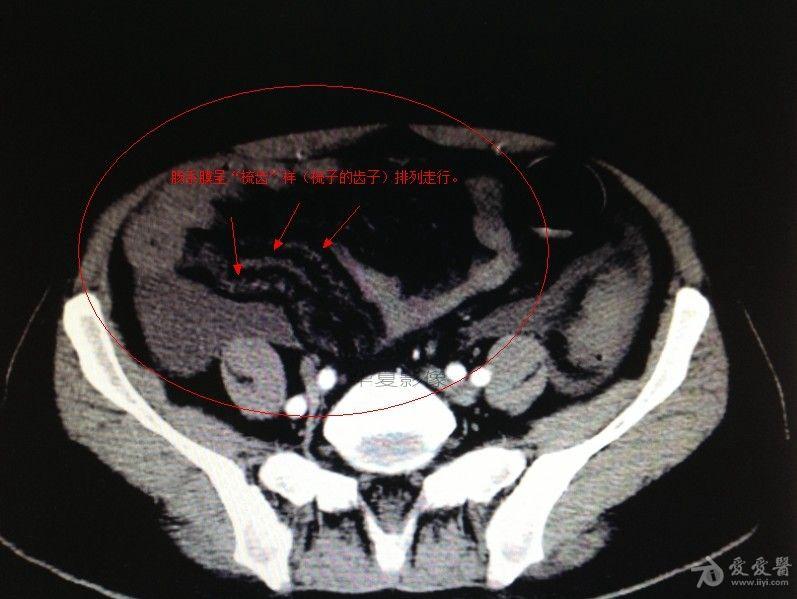肠系膜扭转ct表现图片图片