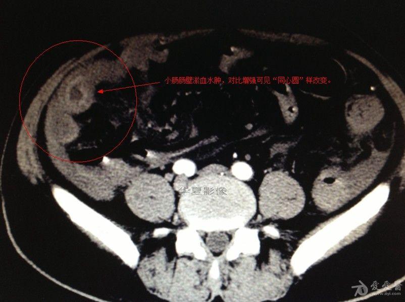 肠系膜扭转ct表现图片图片