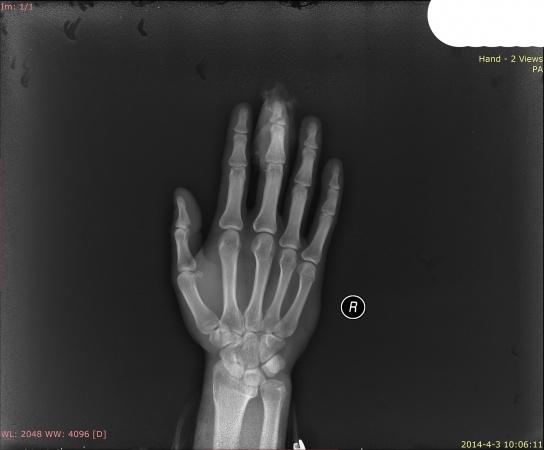 中指末节指骨骨折末节掌侧皮肤缺损 请指导
