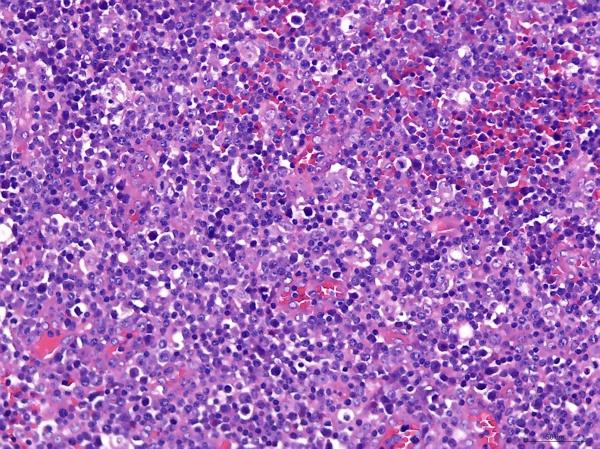 淋巴结肿大一例读片(答案已公布)