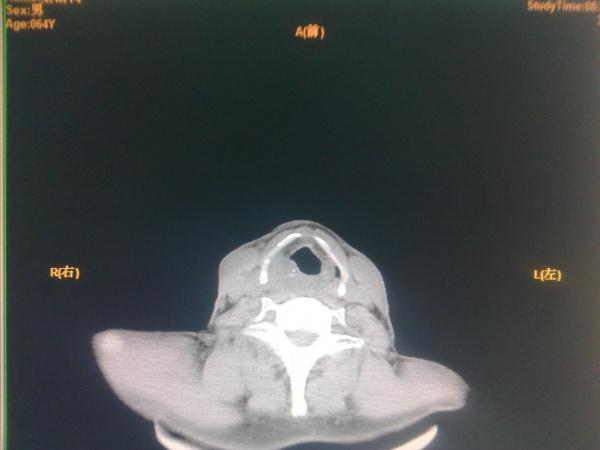 ct:会厌下咽后壁及右侧壁软组织增厚,右侧咽隐窝变窄,咽旁间隙模糊