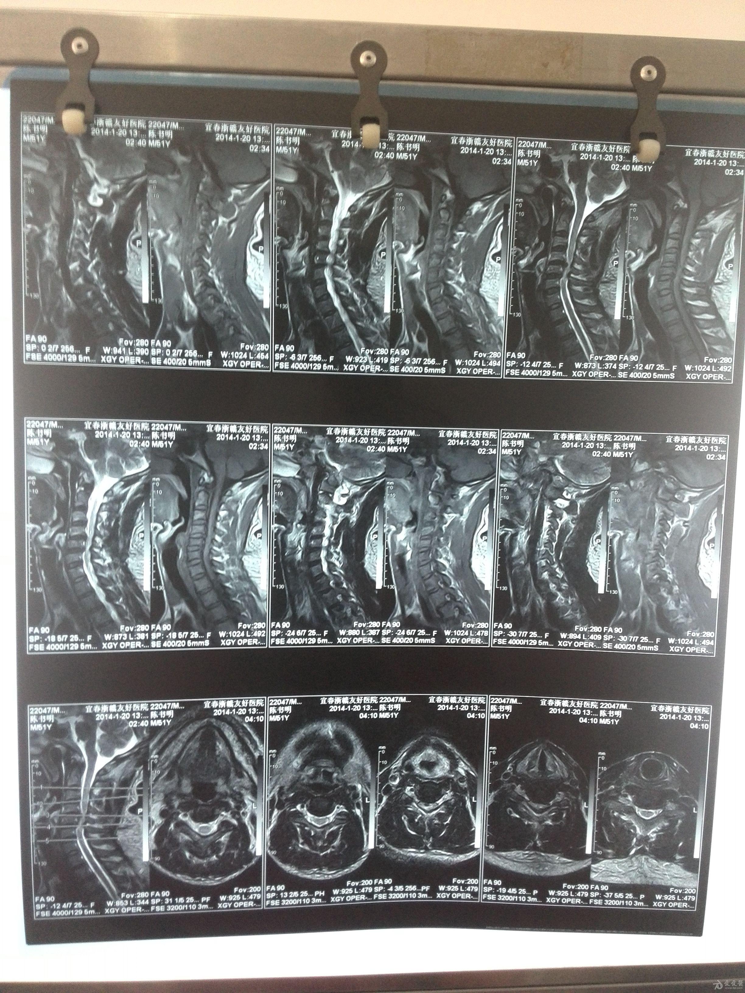 颈椎椎管狭窄 有图有真相
