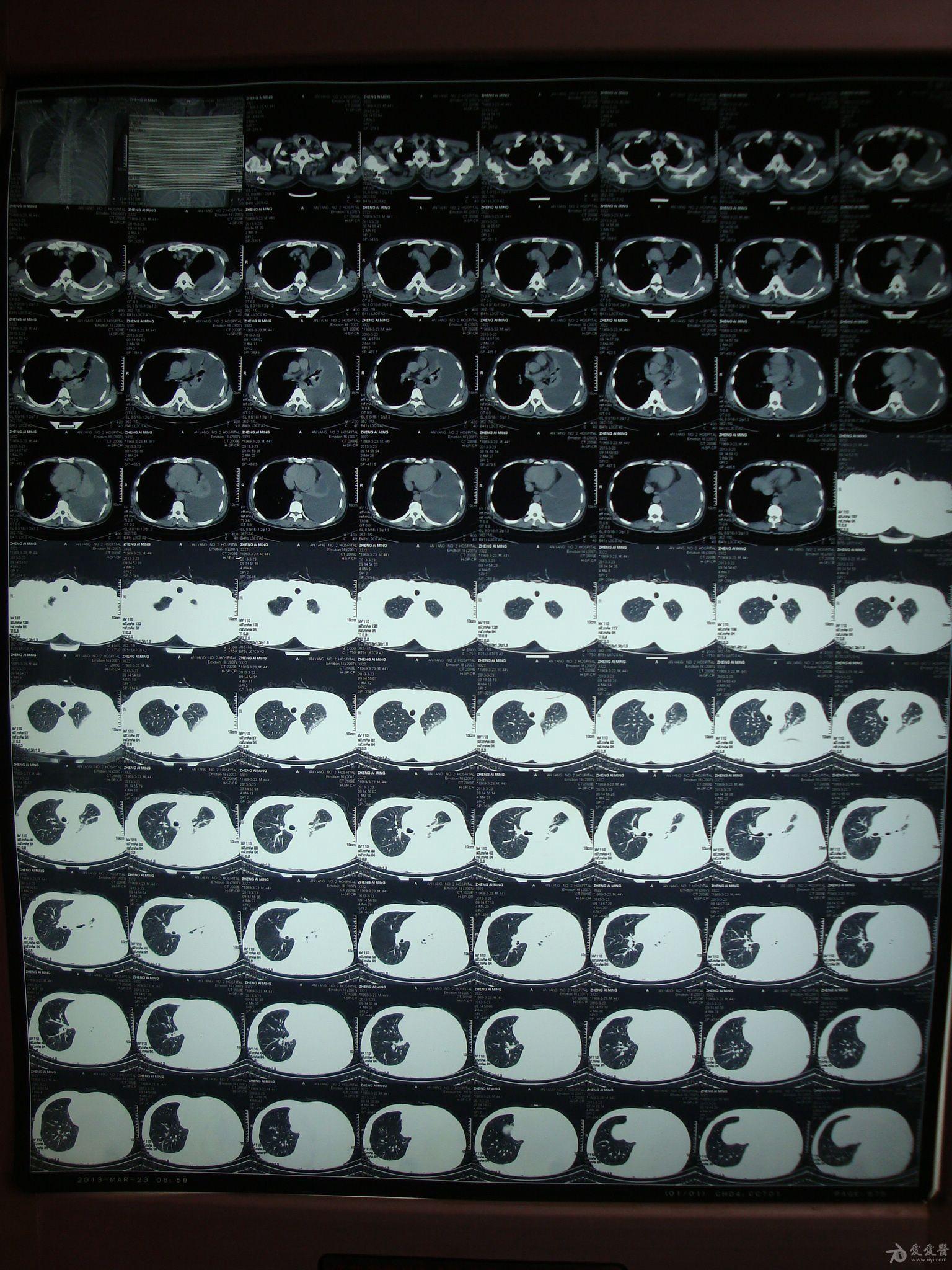 胸膜炎的早期症状ct图图片