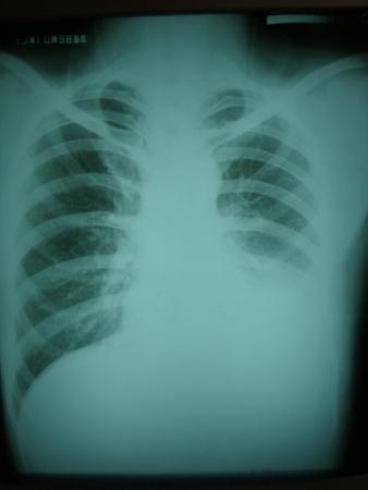 干性胸膜炎图片