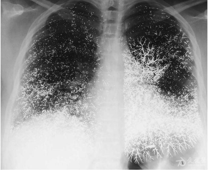 高清耀眼胸片一张,请大家鉴赏
